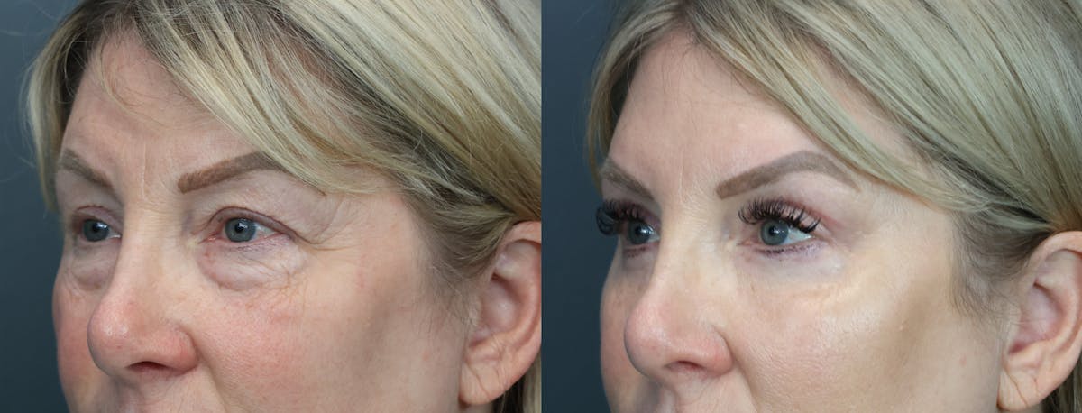Eyelid Surgery Before & After Gallery - Patient 486853 - Image 2