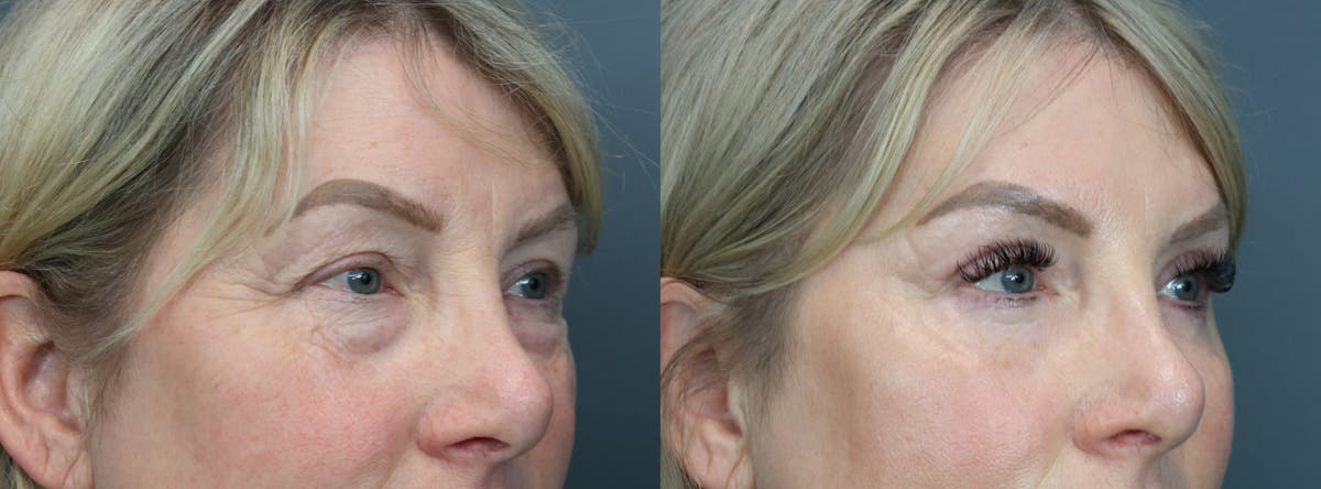 Eyelid Surgery Before & After Gallery - Patient 486853 - Image 3