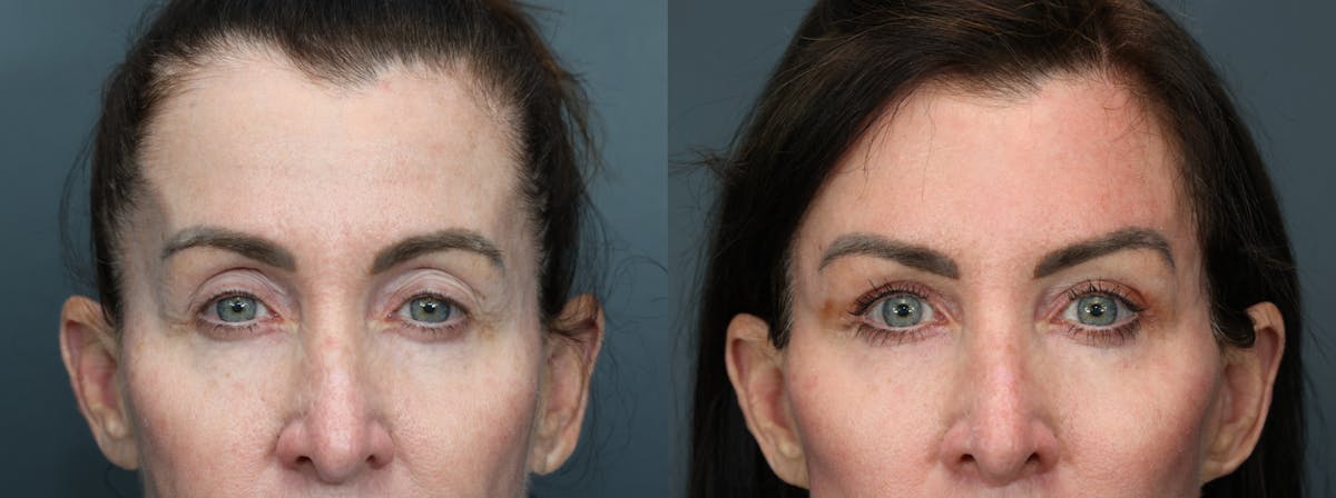 Blepharoplasty Before & After Gallery - Patient 188649 - Image 1