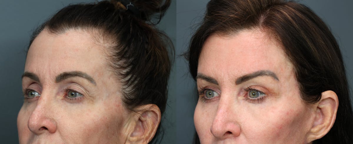 Blepharoplasty Before & After Gallery - Patient 188649 - Image 2