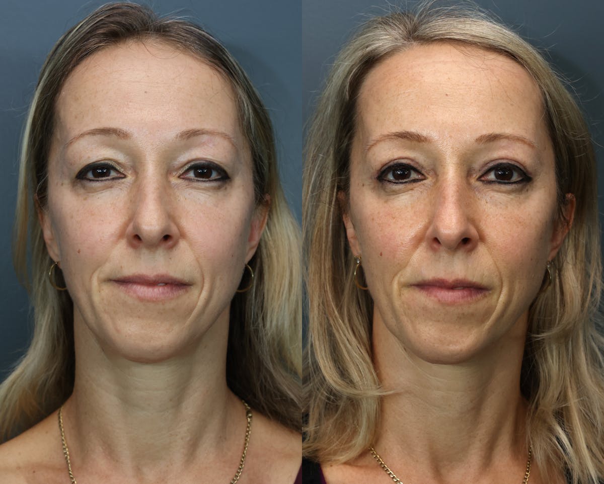 Eyelid Surgery Before & After Gallery - Patient 346001 - Image 1