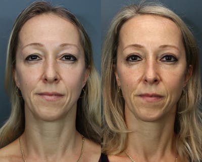 Blepharoplasty Before & After Gallery - Patient 708340 - Image 1