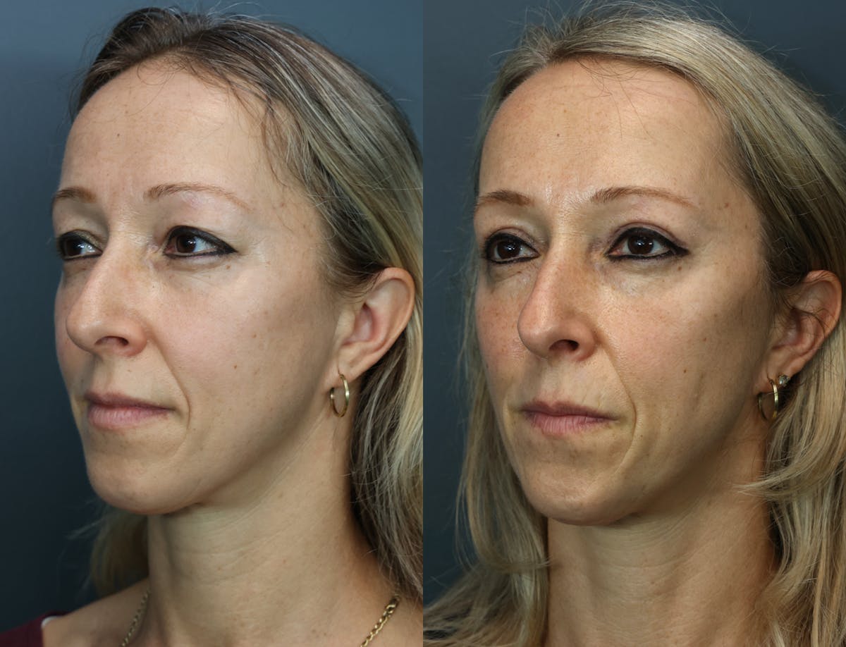 Eyelid Surgery Before & After Gallery - Patient 346001 - Image 2