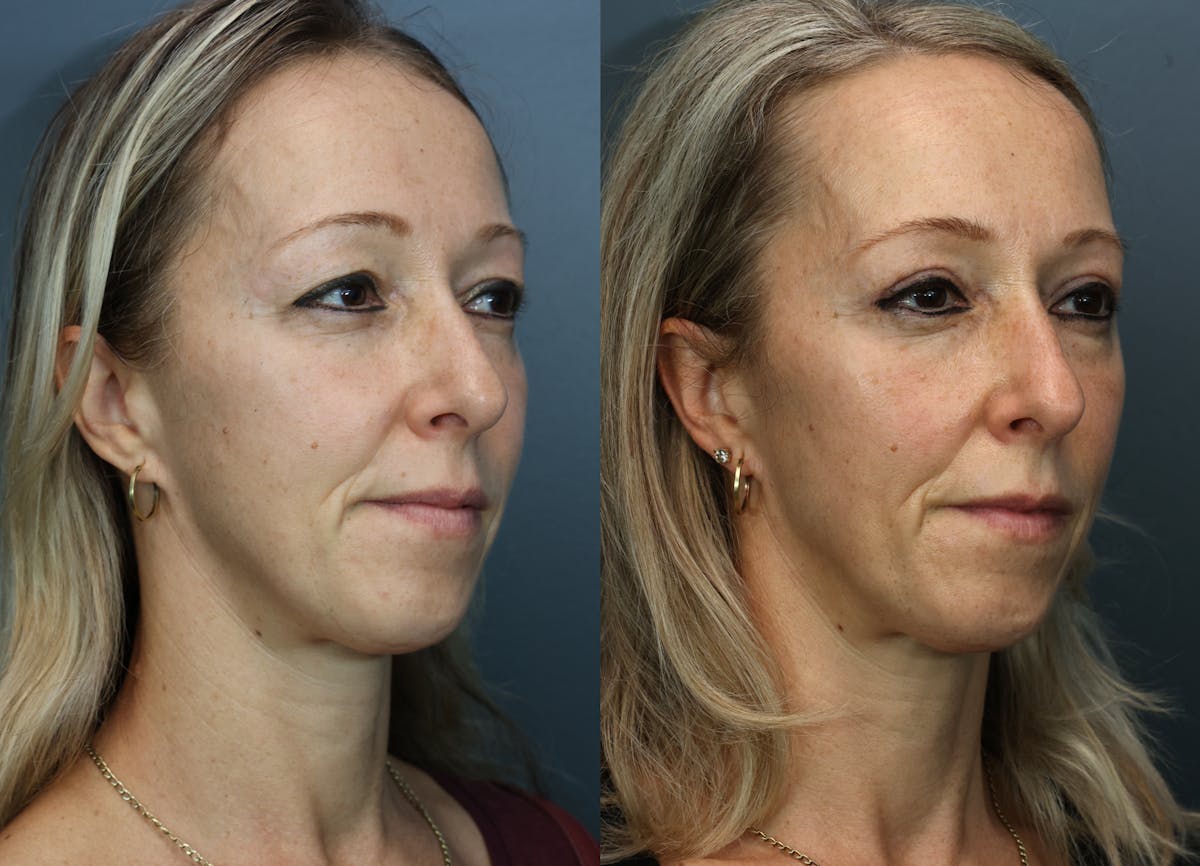 Eyelid Surgery Before & After Gallery - Patient 346001 - Image 3