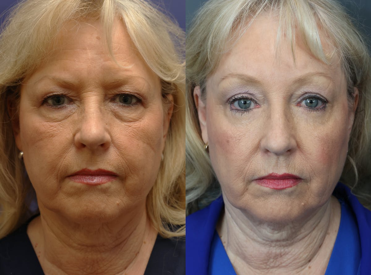 Eyelid Surgery Before & After Gallery - Patient 344958 - Image 1