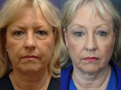 Blepharoplasty Before & After Gallery - Patient 886867 - Image 1