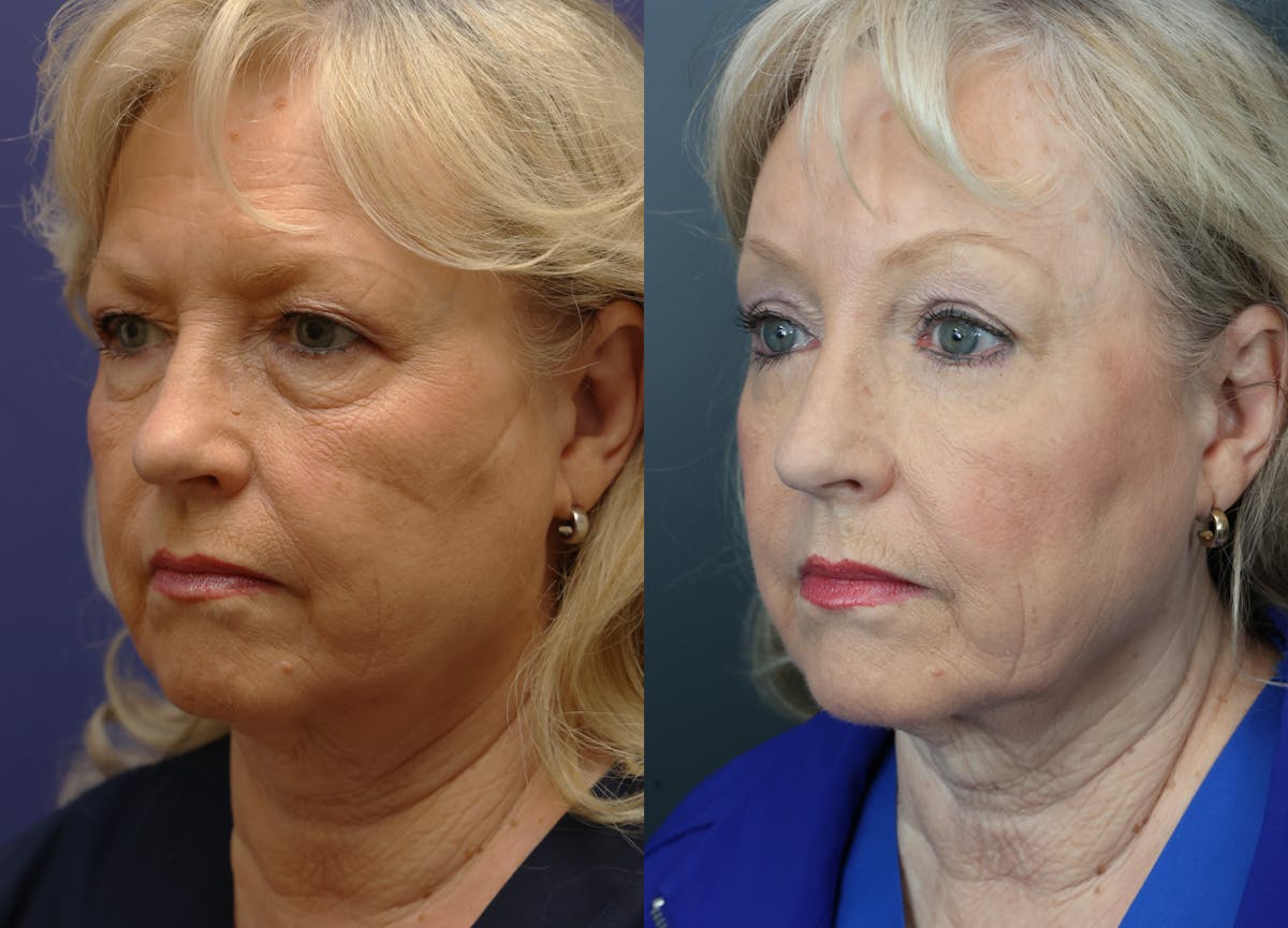 Eyelid Surgery Before & After Gallery - Patient 344958 - Image 2