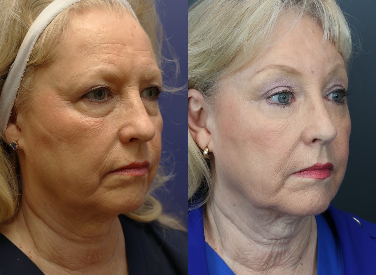 Eyelid Surgery Before & After Gallery - Patient 344958 - Image 3