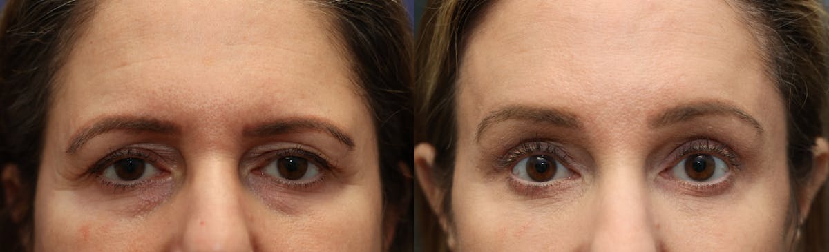 Eyelid Surgery Before & After Gallery - Patient 680515 - Image 1