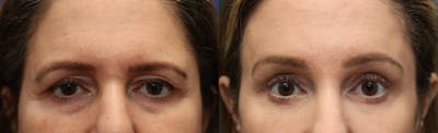 Brow Lift (Forehead Lift) Before & After Gallery - Patient 197373 - Image 1
