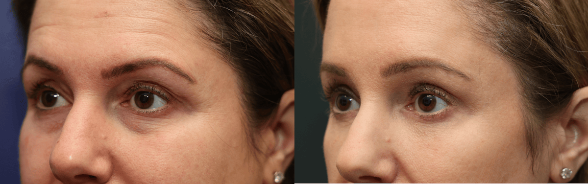 Eyelid Surgery Before & After Gallery - Patient 680515 - Image 2