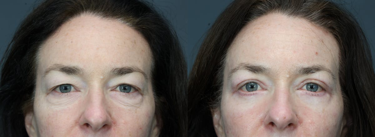 Eyelid Surgery Before & After Gallery - Patient 281971 - Image 1
