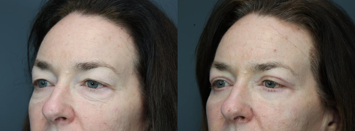 Eyelid Surgery Before & After Gallery - Patient 281971 - Image 2