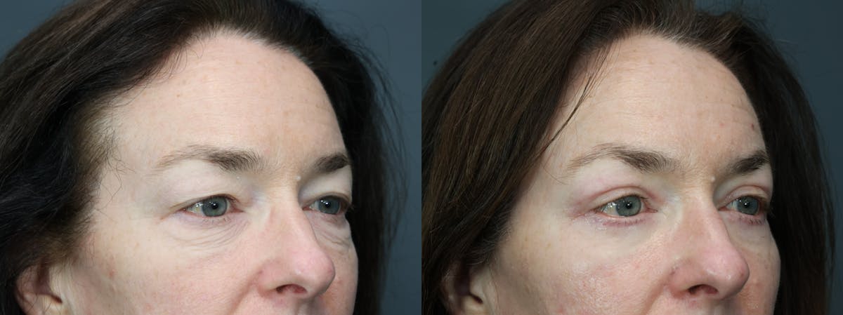 Eyelid Surgery Before & After Gallery - Patient 281971 - Image 3