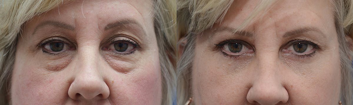 Blepharoplasty Before & After Gallery - Patient 366105 - Image 1