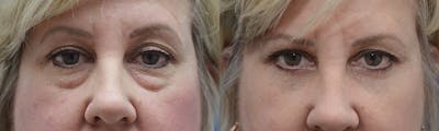 Blepharoplasty Before & After Gallery - Patient 366105 - Image 1