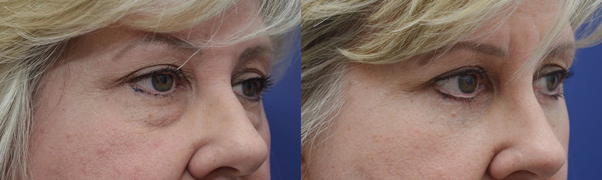 Blepharoplasty Before & After Gallery - Patient 366105 - Image 2