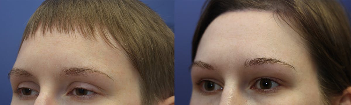 Blepharoplasty Before & After Gallery - Patient 119058 - Image 2