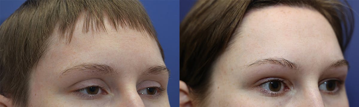 Blepharoplasty Before & After Gallery - Patient 119058 - Image 3