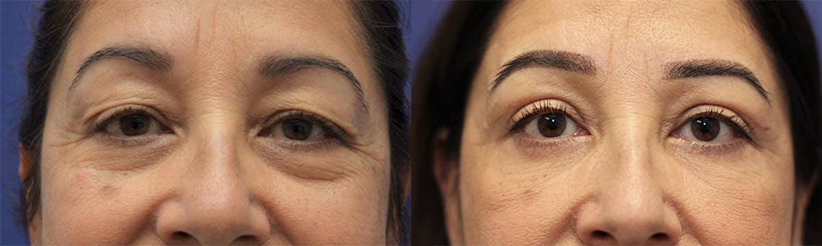 Eyelid Surgery Before & After Gallery - Patient 389489 - Image 1