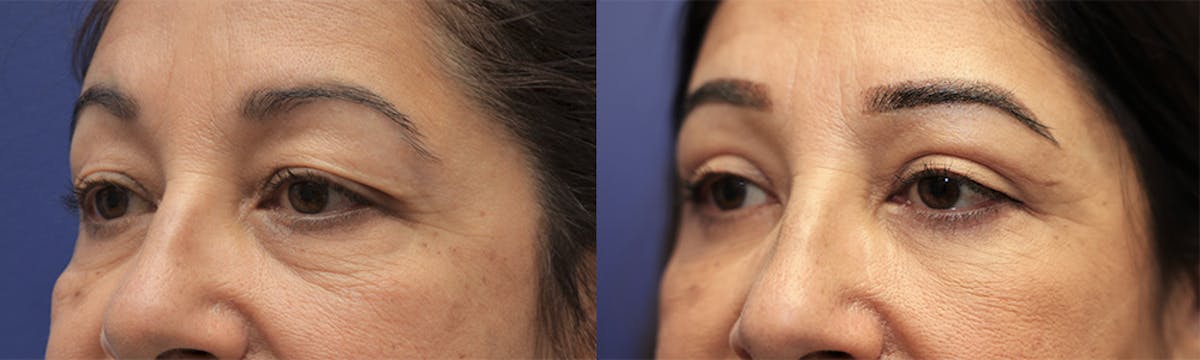 Eyelid Surgery Before & After Gallery - Patient 389489 - Image 2