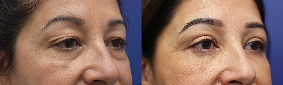 Eyelid Surgery Before & After Gallery - Patient 389489 - Image 3