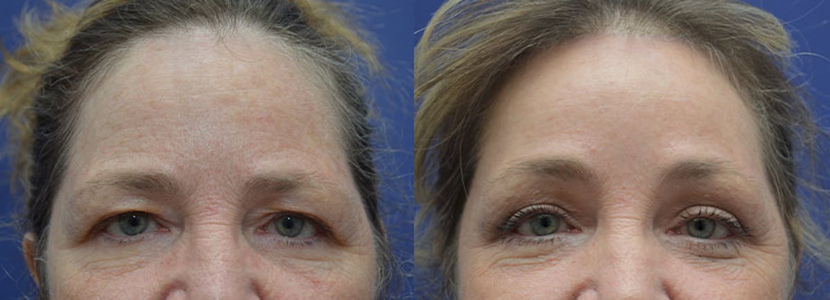 Eyelid Surgery Before & After Gallery - Patient 100709 - Image 1