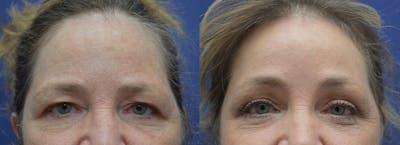 Brow Lift (Forehead Lift) Before & After Gallery - Patient 427194 - Image 1