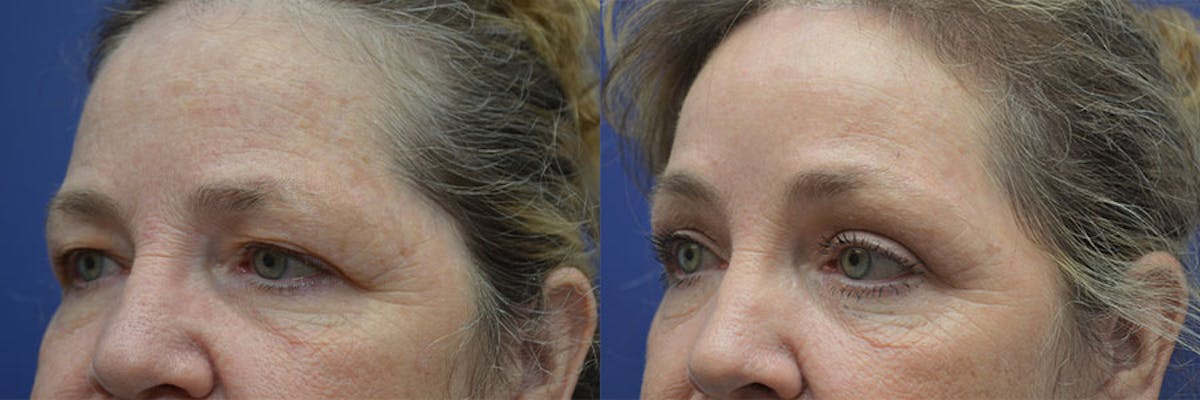 Eyelid Surgery Before & After Gallery - Patient 100709 - Image 2