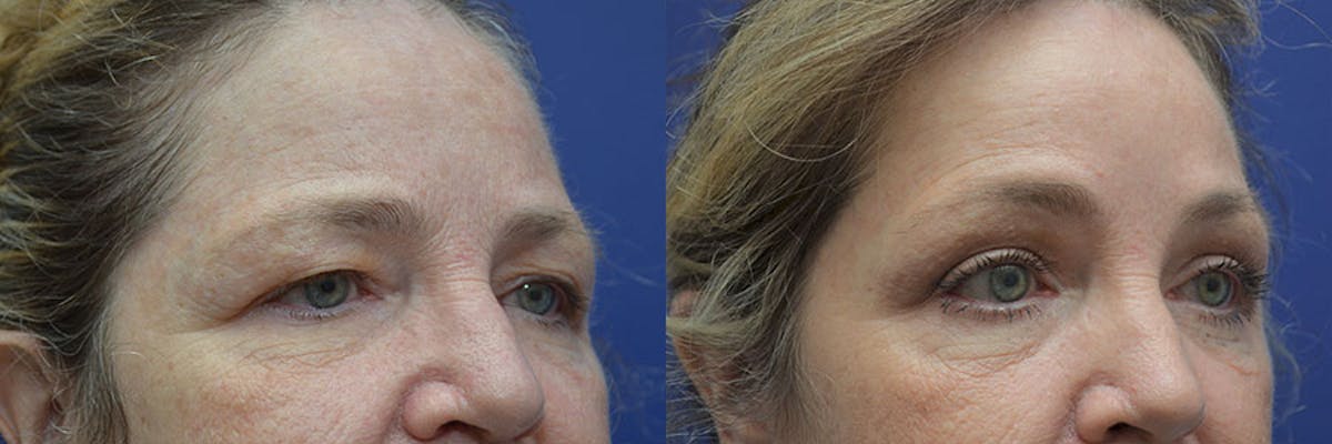 Eyelid Surgery Before & After Gallery - Patient 100709 - Image 3