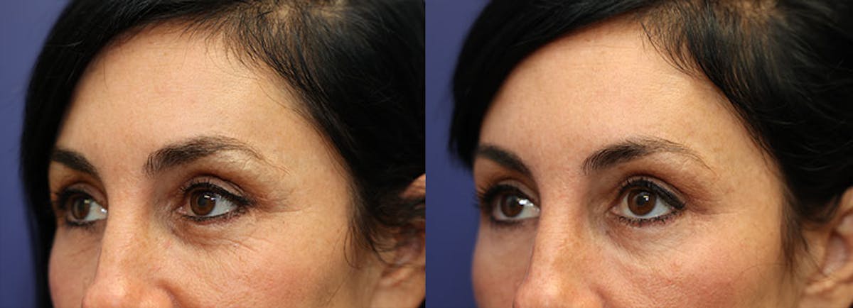 Eyelid Surgery Before & After Gallery - Patient 252334 - Image 2