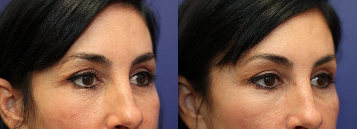 Eyelid Surgery Before & After Gallery - Patient 252334 - Image 3