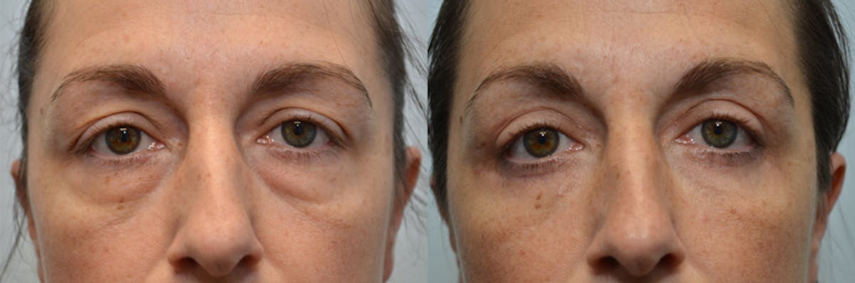 Eyelid Surgery Before & After Gallery - Patient 406337 - Image 1