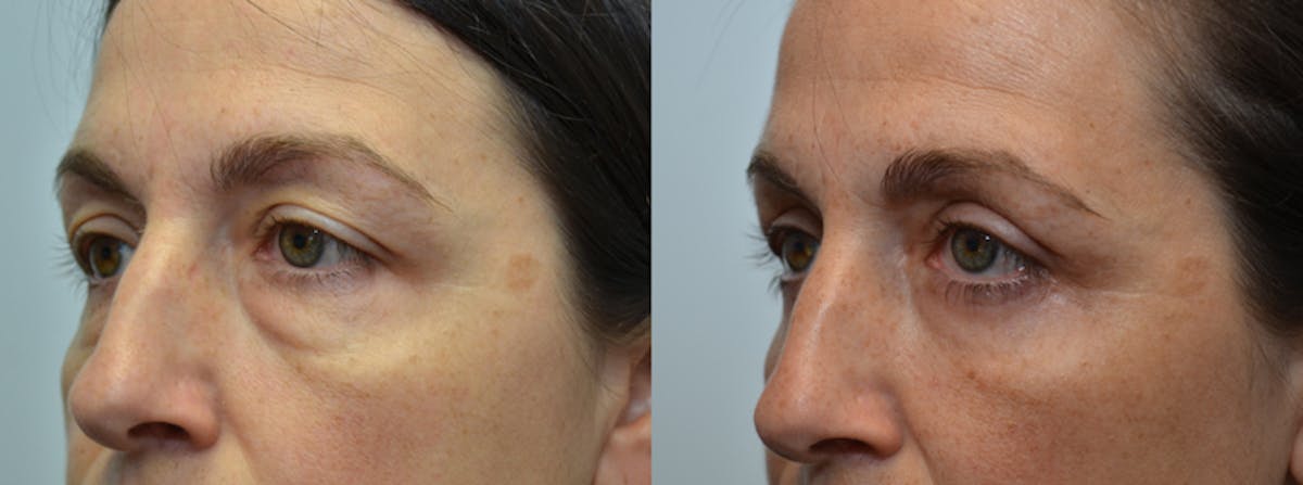 Eyelid Surgery Before & After Gallery - Patient 406337 - Image 2