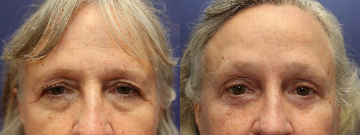 Eyelid Surgery Before & After Gallery - Patient 324278 - Image 2