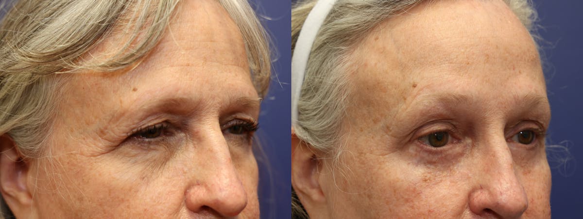 Eyelid Surgery Before & After Gallery - Patient 324278 - Image 3