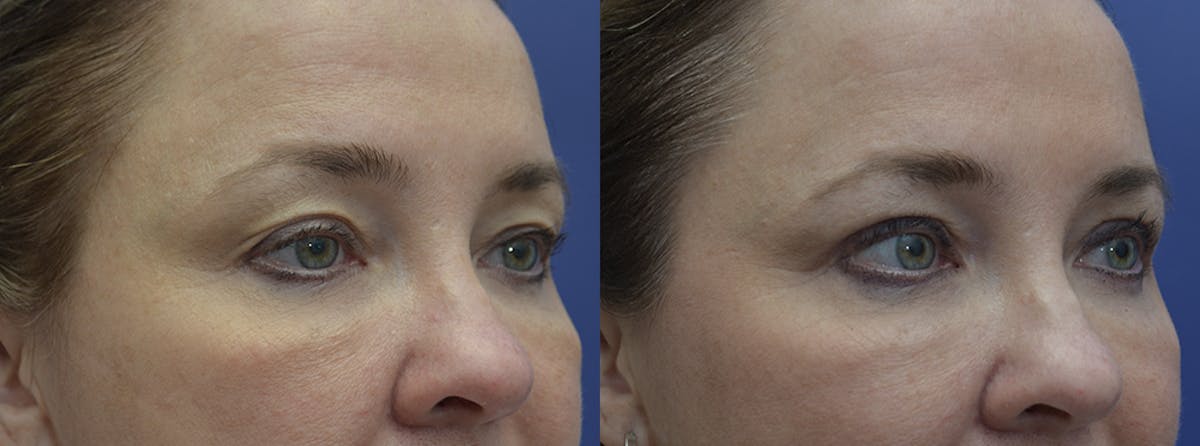 Eyelid Surgery Before & After Gallery - Patient 282022 - Image 1