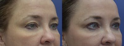 Blepharoplasty Before & After Gallery - Patient 427468 - Image 1