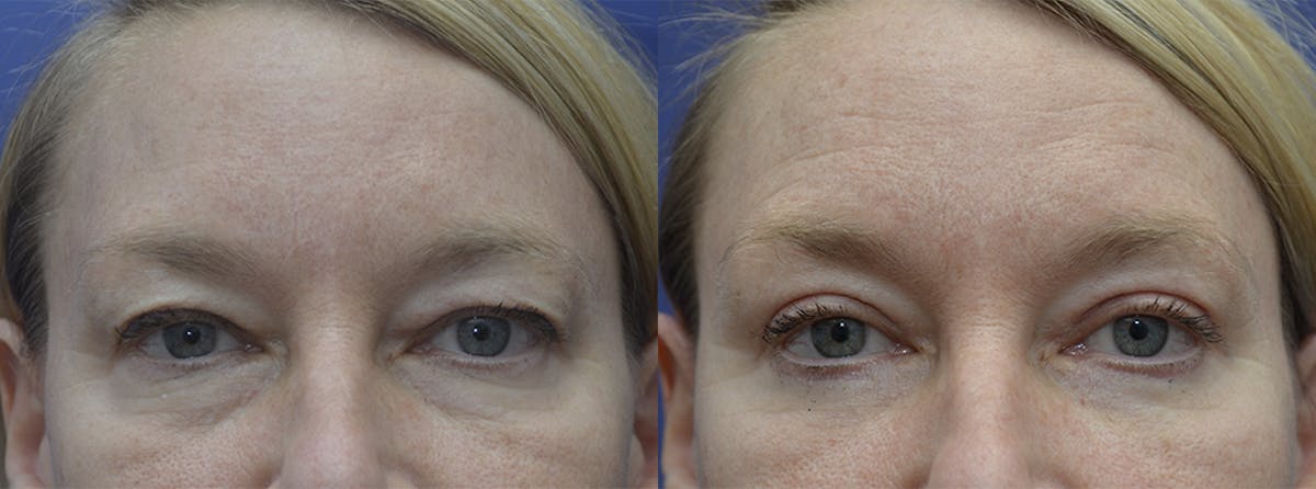 Eyelid Surgery Before & After Gallery - Patient 425702 - Image 1
