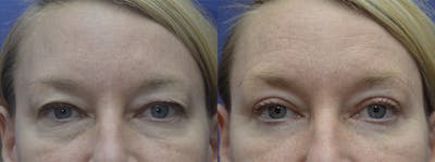 Blepharoplasty Before & After Gallery - Patient 387015 - Image 1