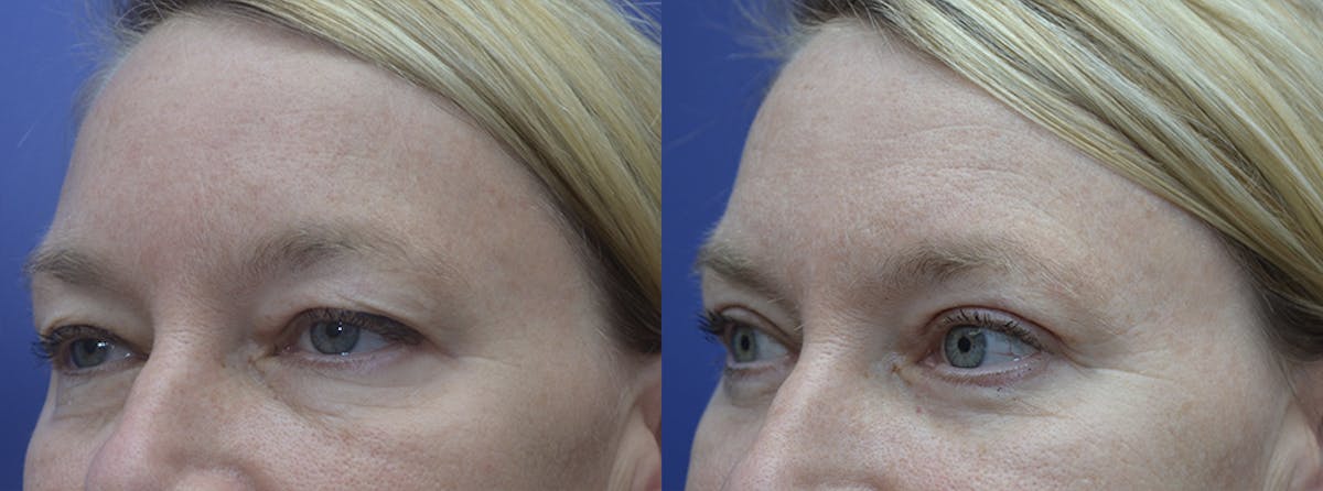 Eyelid Surgery Before & After Gallery - Patient 425702 - Image 2