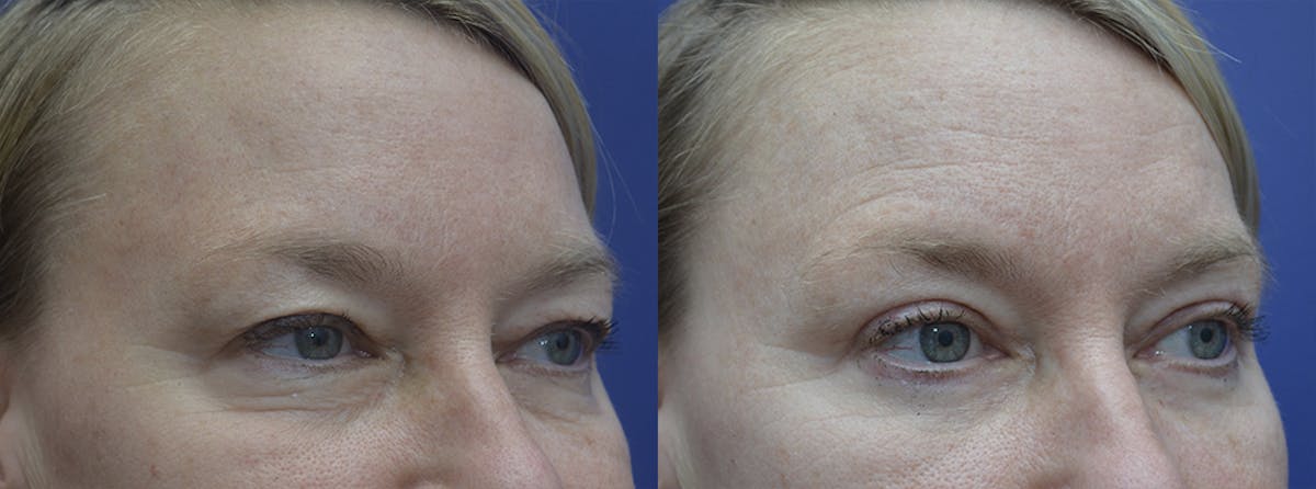 Eyelid Surgery Before & After Gallery - Patient 425702 - Image 3