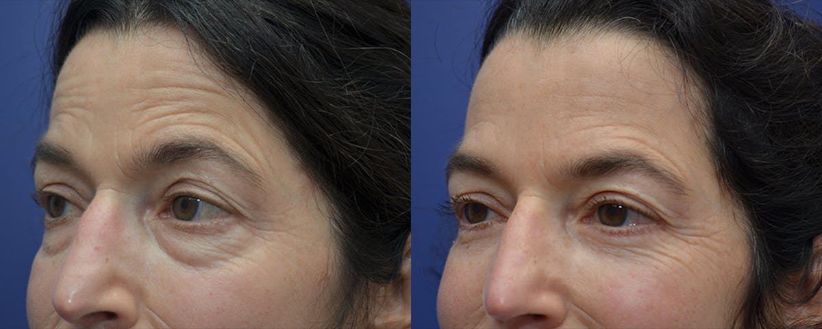 Eyelid Surgery Before & After Gallery - Patient 178431 - Image 1