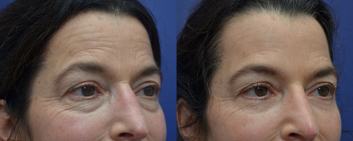 Eyelid Surgery Before & After Gallery - Patient 178431 - Image 2