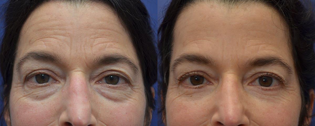 Eyelid Surgery Before & After Gallery - Patient 178431 - Image 3