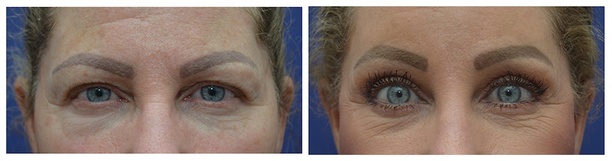 Eyelid Surgery Before & After Gallery - Patient 287375 - Image 1