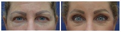 Blepharoplasty Before & After Gallery - Patient 579366 - Image 1