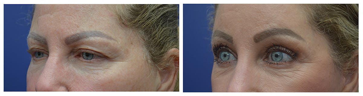 Eyelid Surgery Before & After Gallery - Patient 287375 - Image 2