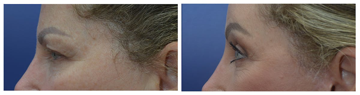 Eyelid Surgery Before & After Gallery - Patient 287375 - Image 3