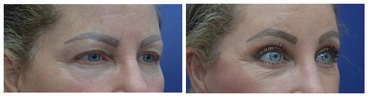 Eyelid Surgery Before & After Gallery - Patient 287375 - Image 4